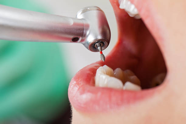 Best Broken or Chipped Tooth Repair in Greenville, GA